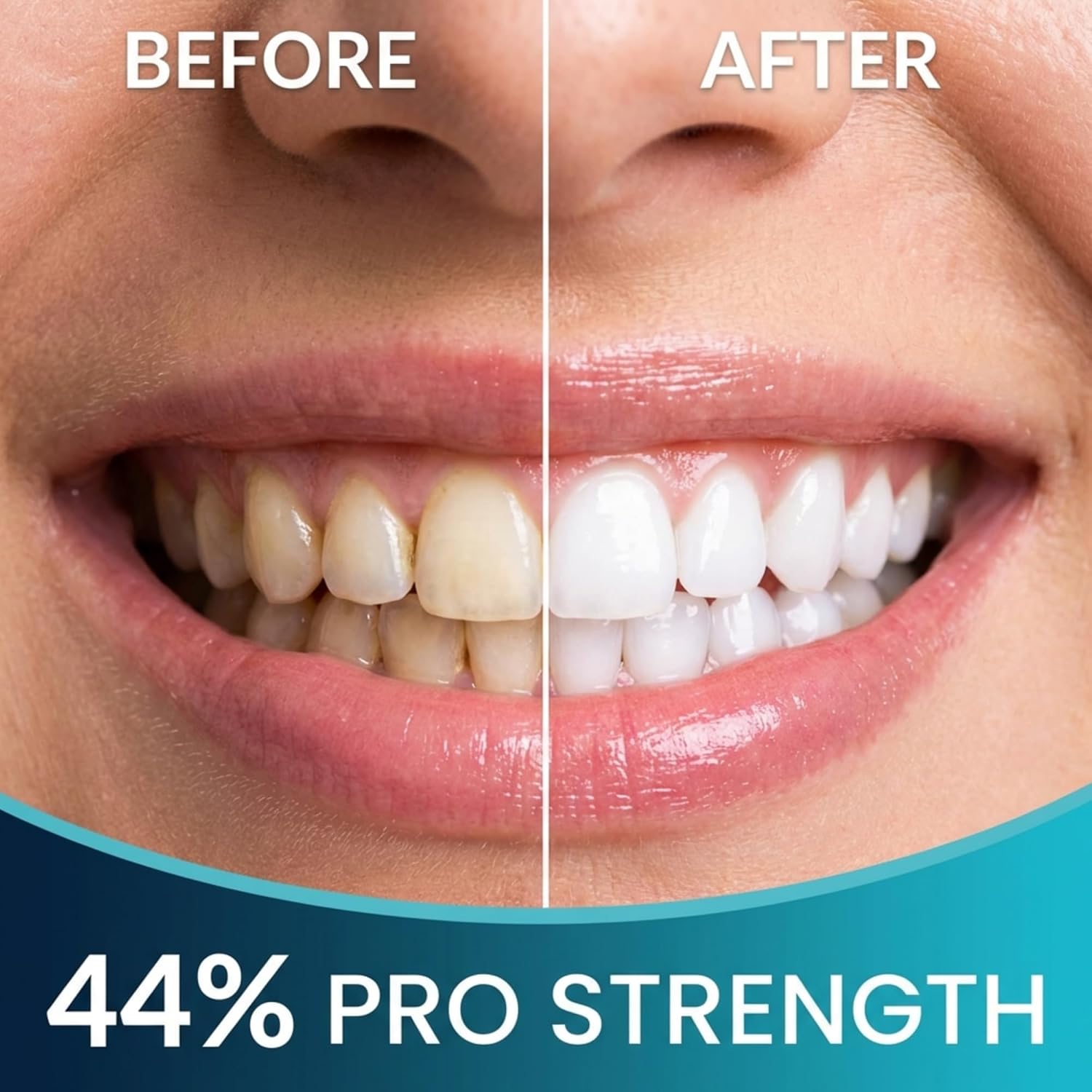 Cool Teeth Whitening 44% Gel Kit - 5 Pack & 2 Trays