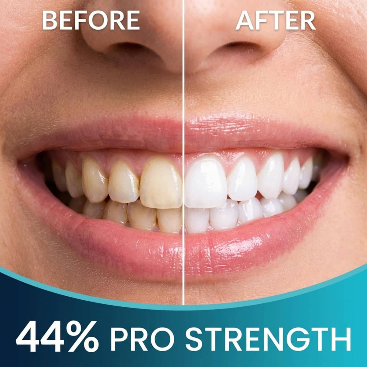 Close-up before-and-after comparison of a person's smile, showing yellowed teeth on the left and brighter white teeth on the right, with text reading BEFORE, AFTER, and 44% PRO STRENGTH.